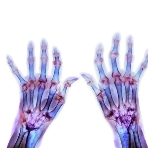 Rheumatoid arthritis, X-ray F008 / 3500