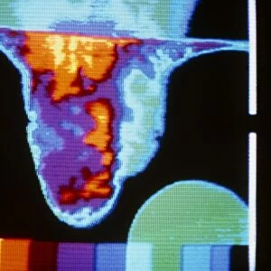 Thermogram of varicocele in right of scrotum