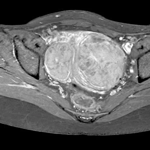 Uterine fibroids, MRI scan C018 / 0466