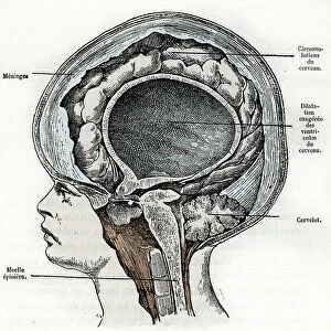 Representation of a young hydrocephal child with brain deformation (Hydrocephalus) Engraving from " Nature and Man" by Rengade 1881 Private collection A
