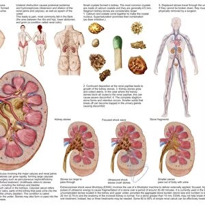 Medical chart showing the signs and symptoms of kidney stones