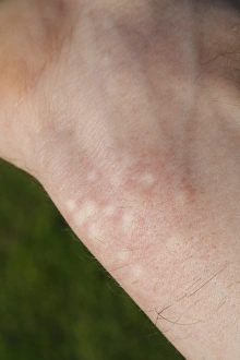 Stinging Prints: Stinging Nettle (Urtica dioica) stung human wrist, Suffolk, England, may